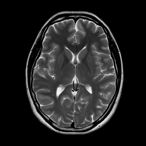 脳MRI