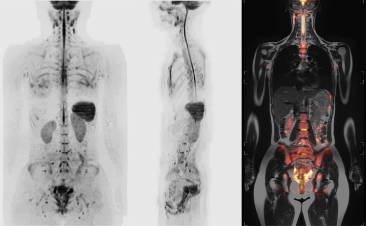 全身MRIがん検査「DWIBS（ドゥイブス）」